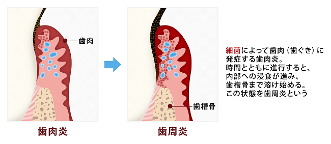 歯肉炎と歯周病