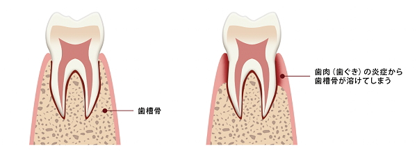 歯周病