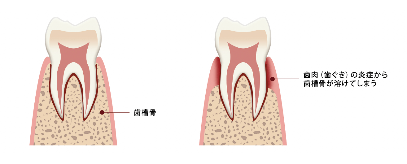 歯周病